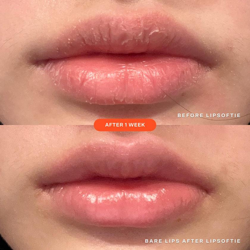 LipSoftie® Lip Treatment For Sale