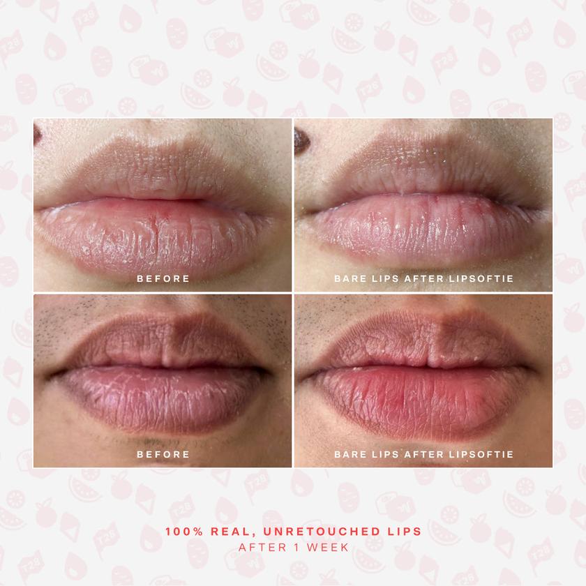 LipSoftie® Lip Treatment For Sale