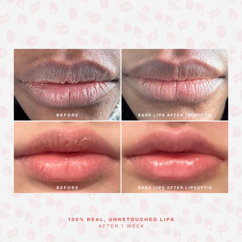 LipSoftie® Lip Treatment For Sale